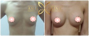 before after breast implants thailand