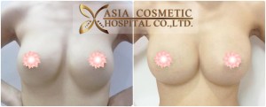 breast augmentation in thailand , the best in thailand