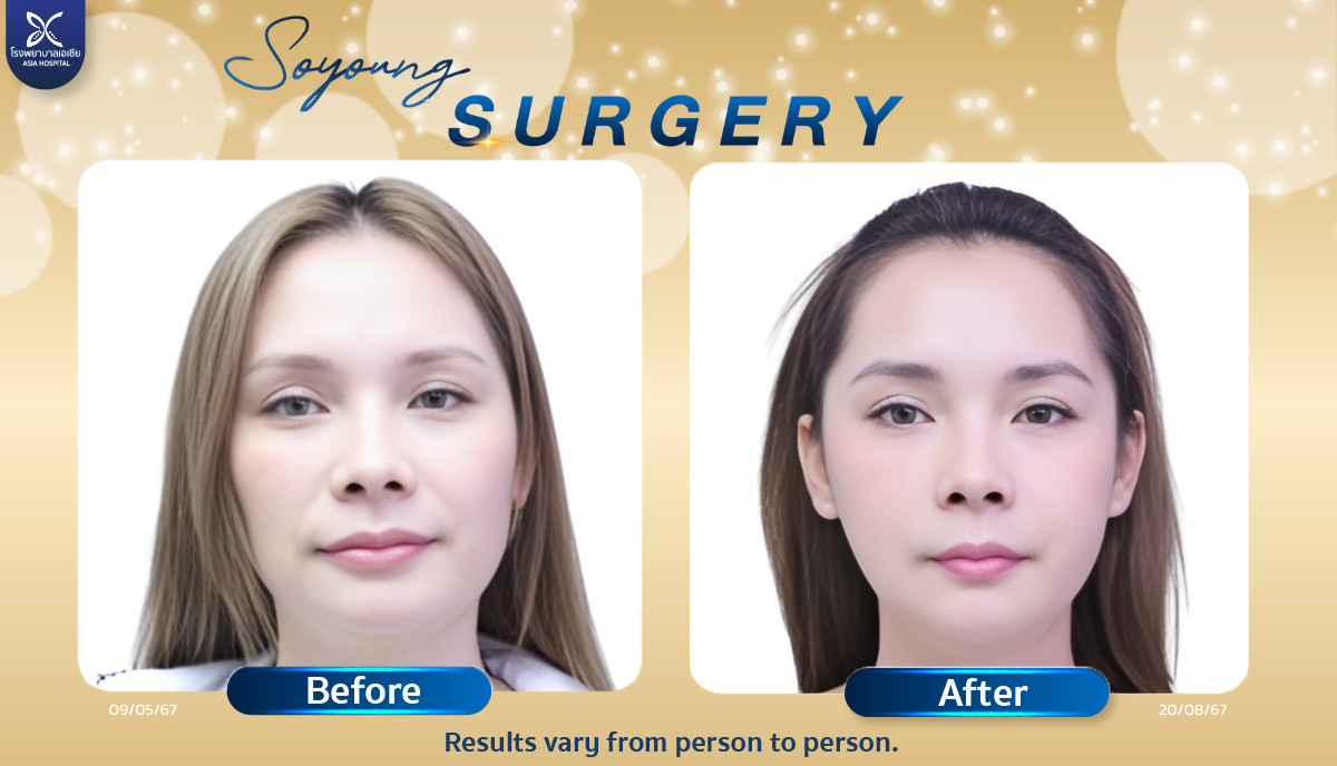 Jaw Reduction Surgery