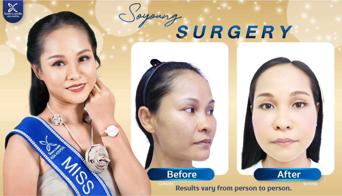 Jaw bone shaving surgery