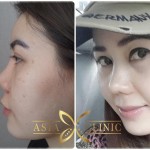 best nose surgery in thailand