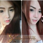 nose implants in thailand