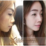 nose job in thailand asia cosmetic hospital