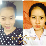 nose surgery at asia clinic