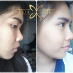 reviews rhinoplasty at asia cosmetic thailand
