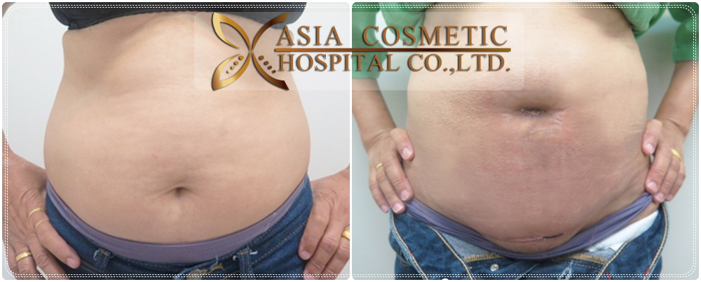 Liposuction story of Chea from Indonesia – IDHOSPITAL