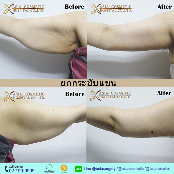 armlift thailand