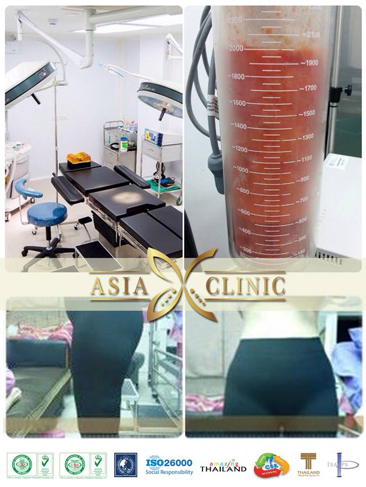 liposuction in thailand