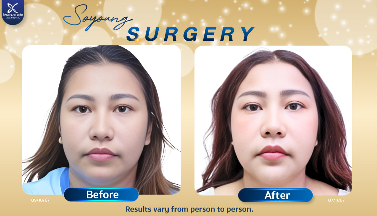 Asia Cosmetic Hospital Cheekbone Reduction Surgery