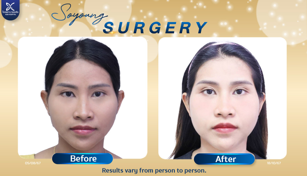Asia Hospital Cheekbone Reduction Surgery