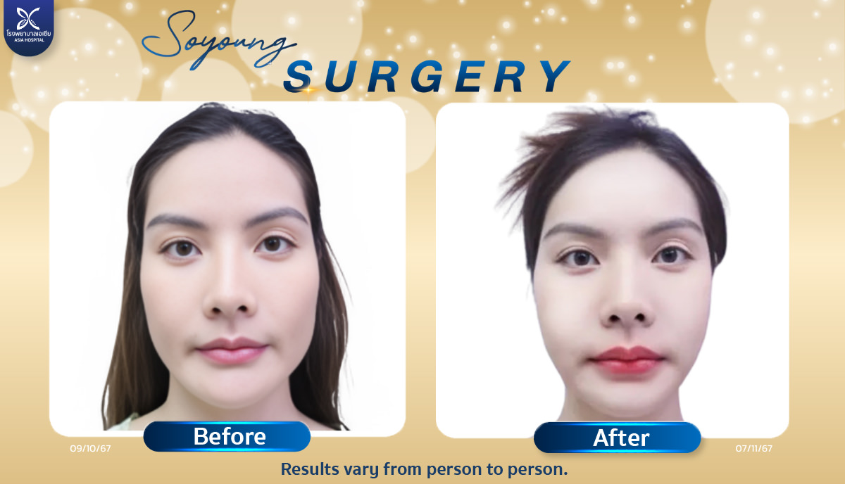 Cheekbone Reduction