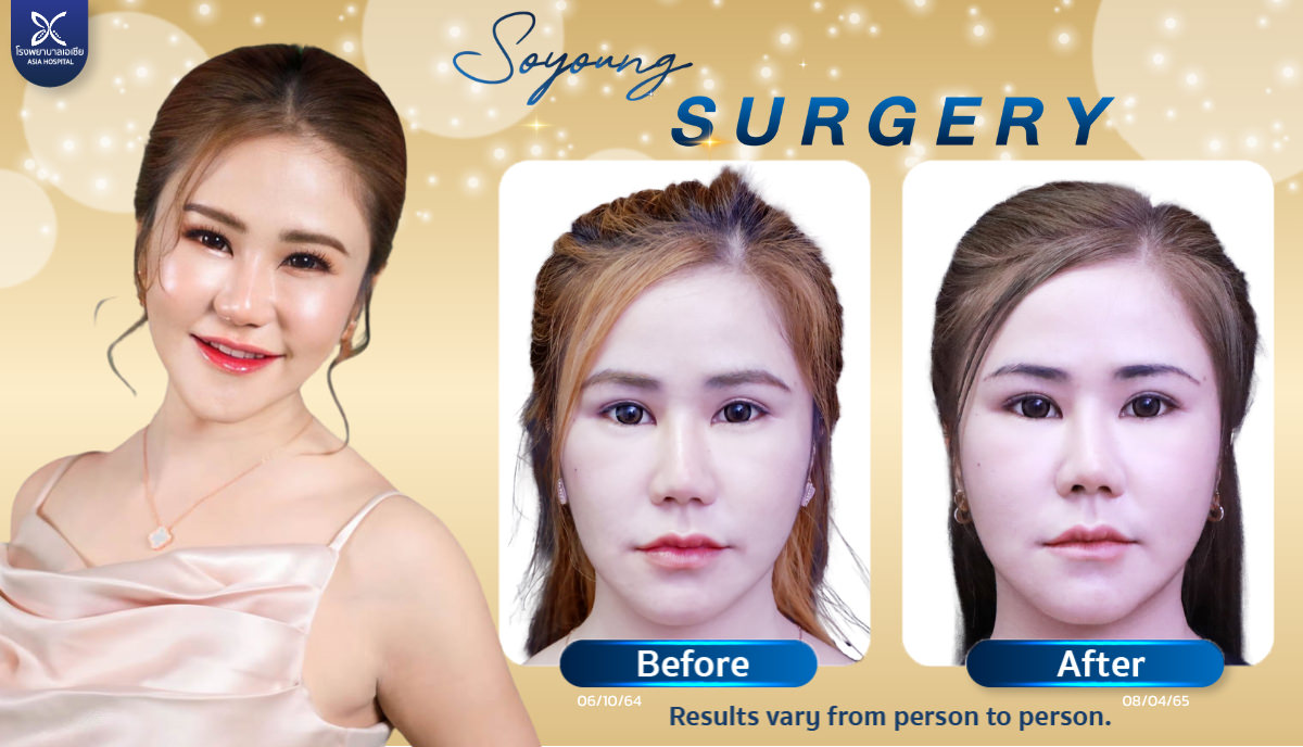 Cheekbone Reduction Surgery