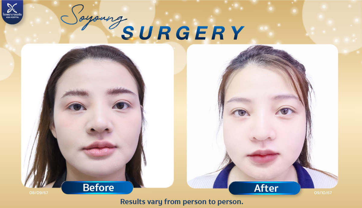 Cheekbone Reduction Surgery - Asia Cosmetic Hospital