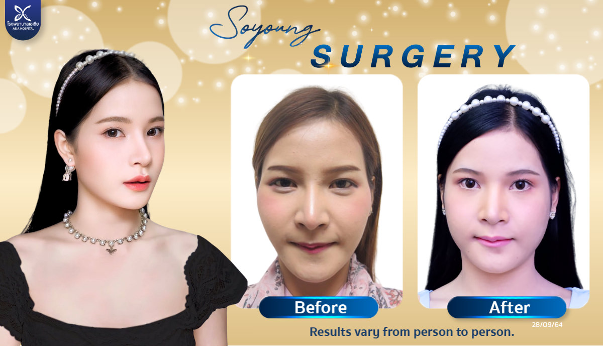 Cheekbone Reduction Surgery Asia Hospital Thailand