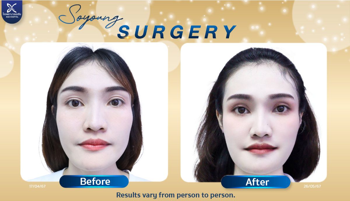 Cheekbone Reduction Surgery Asia cosmetic hospital in thailand