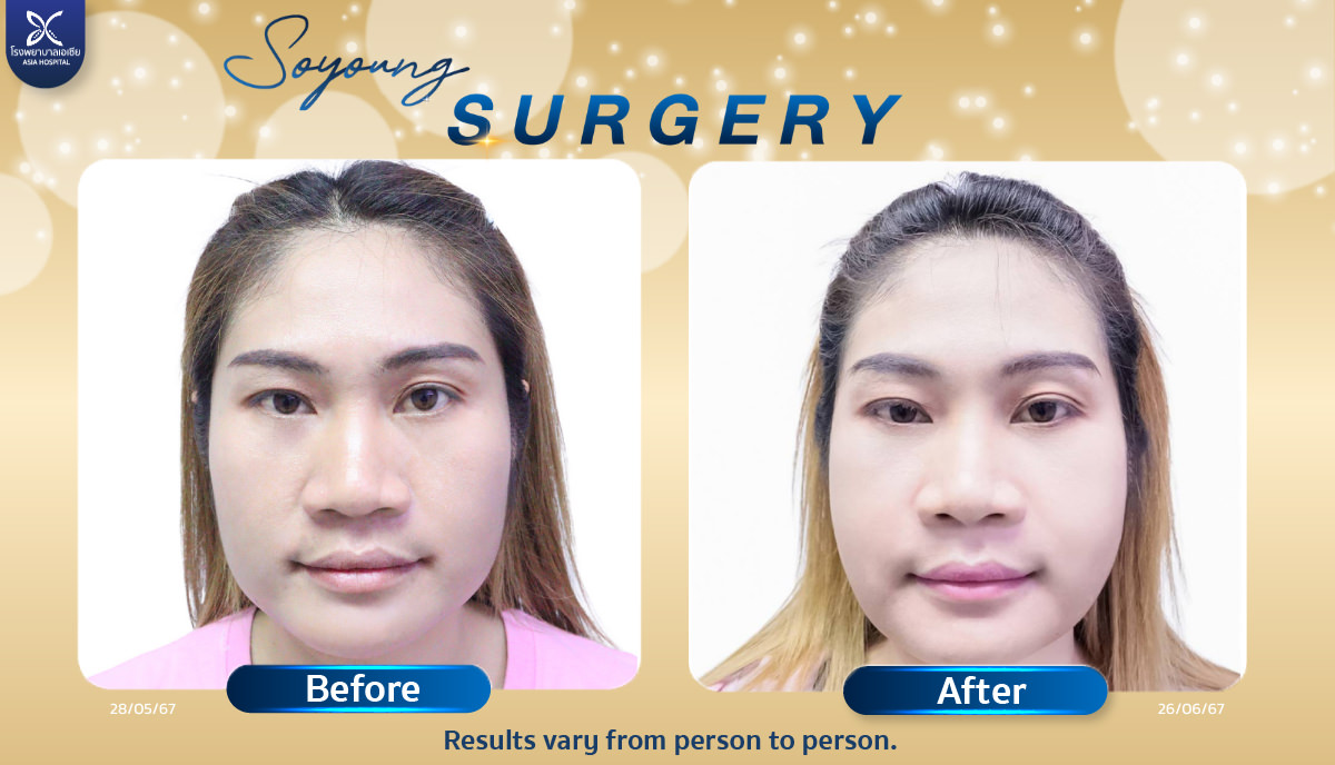 Cheekbone Reduction Surgery-Bangkok-Thailand