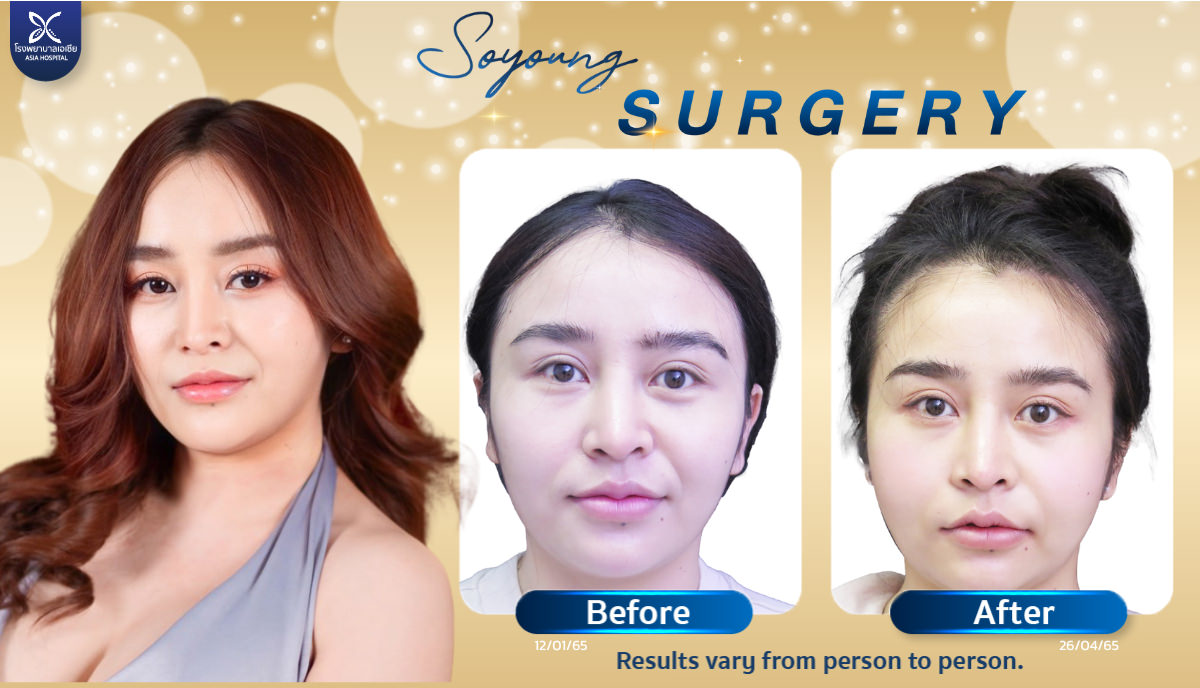 Cheekbone Reduction Surgery Jaw Angle Reduction