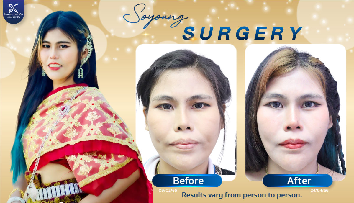 Cheekbone Reduction Surgery Jaw Bone Shaving