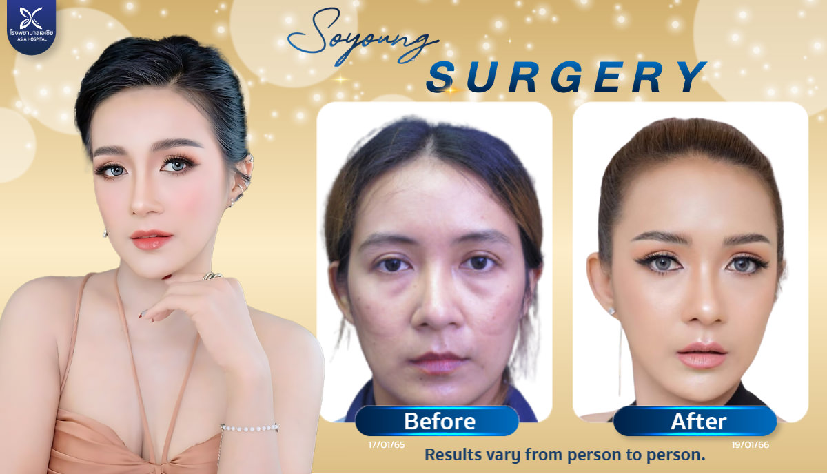 Cheekbone Reduction Surgery Jaw Reduction