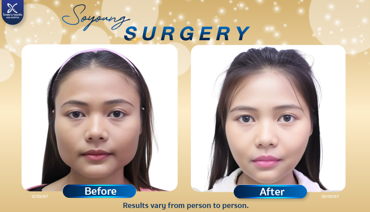 Cheekbone Reduction Surgery Jaw bone V-Line