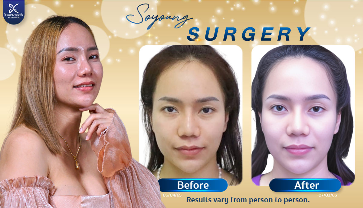 Cheekbone Reduction Surgery V-Line Asia Cosmetic Hospital
