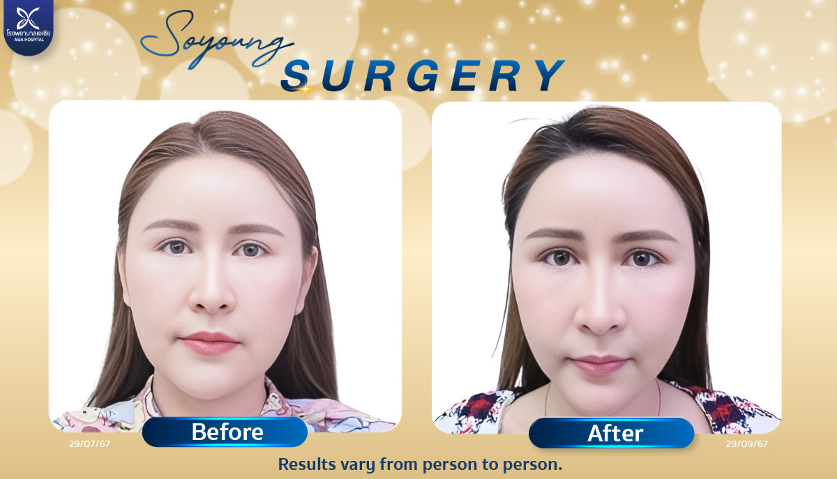 Cheekbone Reduction Surgery V-Line Bangkok Thailand