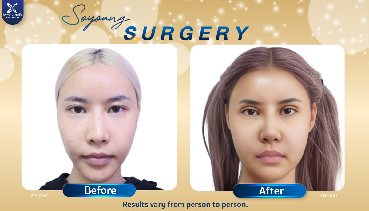 Cheekbone Reduction Surgery in Thailand