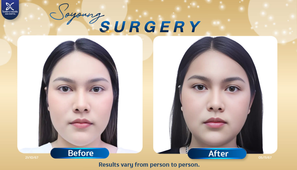 Cheekbone Reduction Surgery reviews