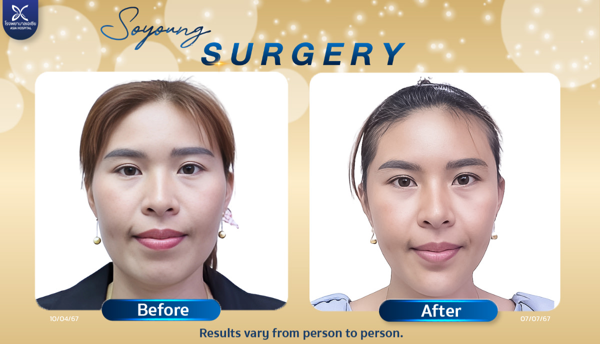Cheekbone Reduction Surgery21