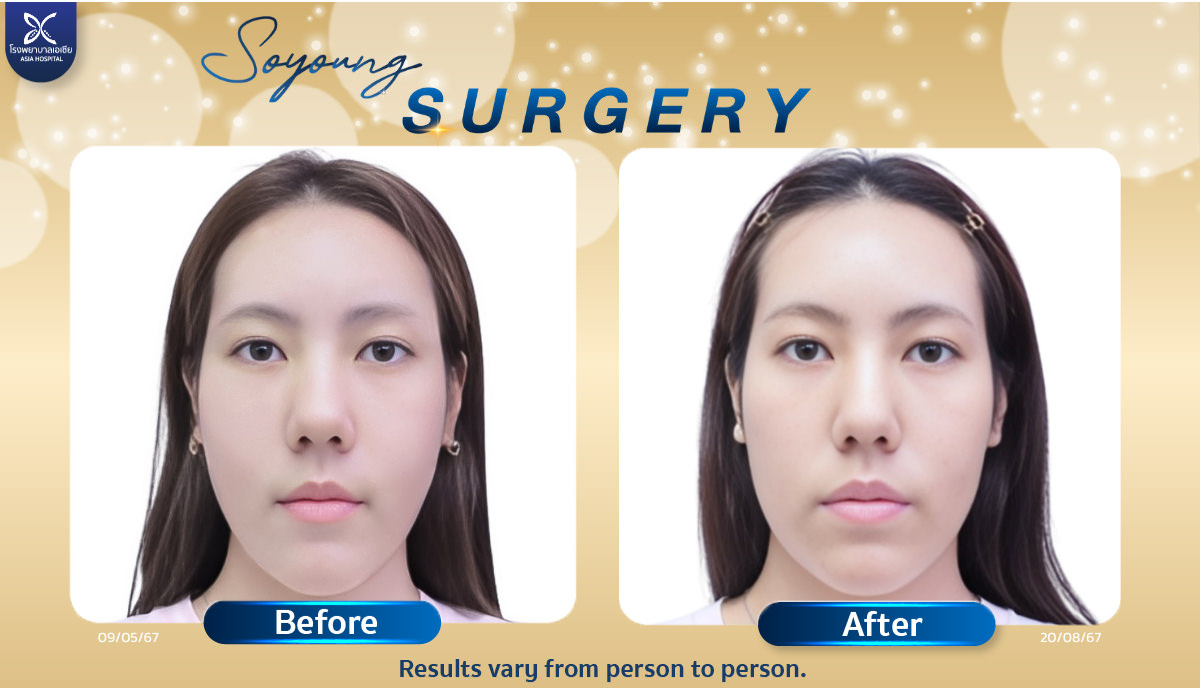 Jaw Cheekbone Reduction Surgery Bangkok Thailand