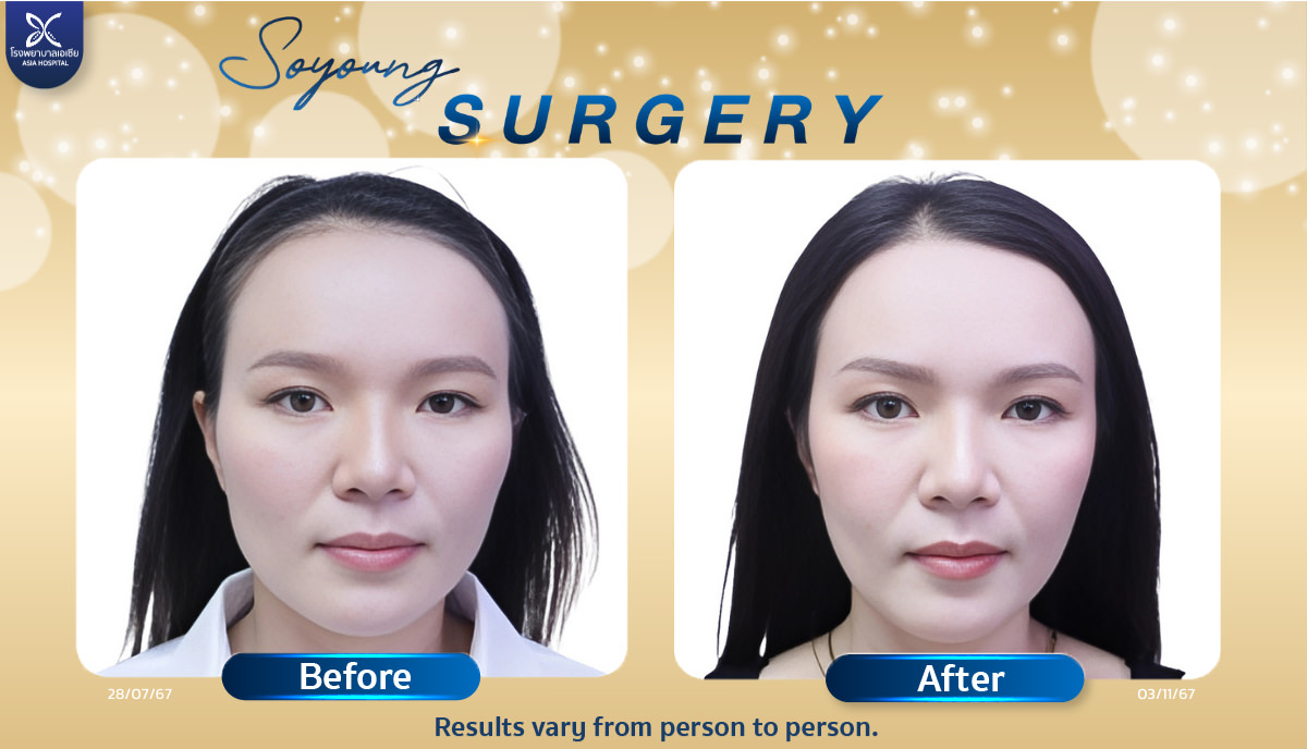 V-Line Cheekbone Reduction Surgery Bangkok Thailand
