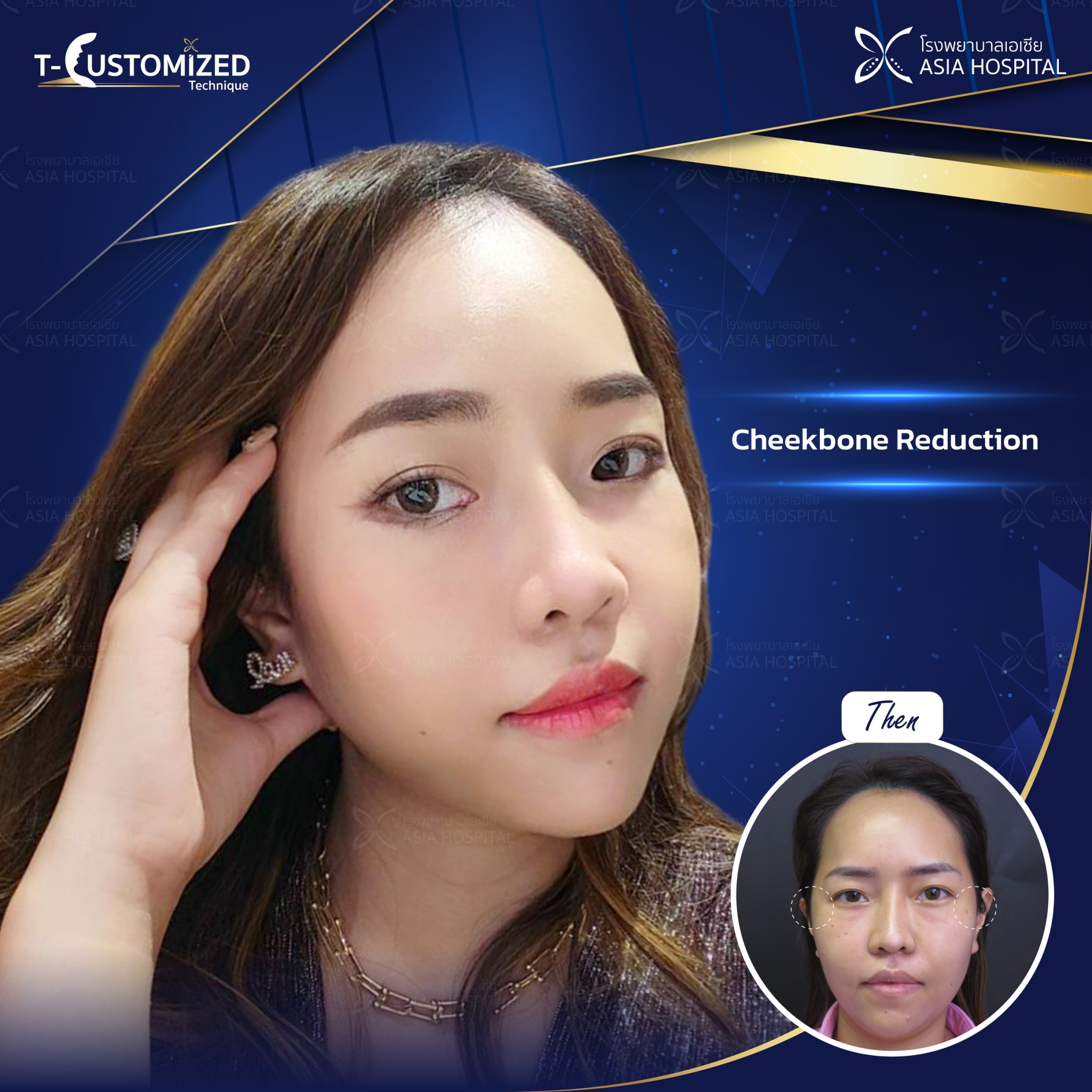 cheekbone-jaw-reduction-thailand