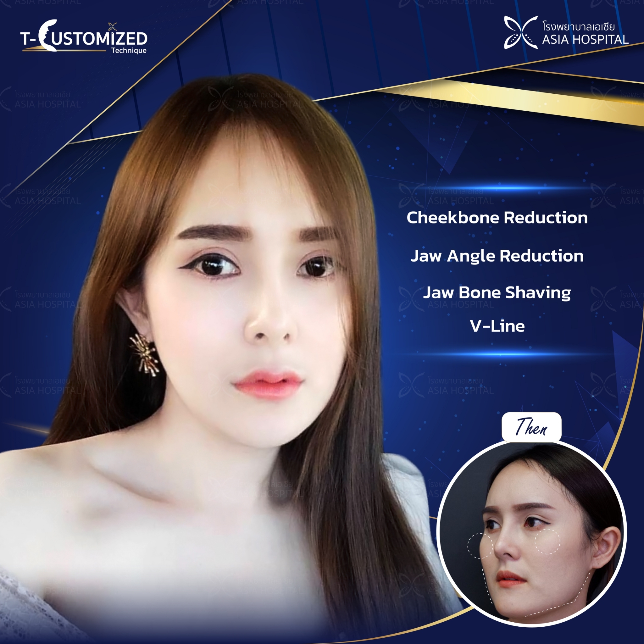 cheekbone-jaw-reduction-thailand