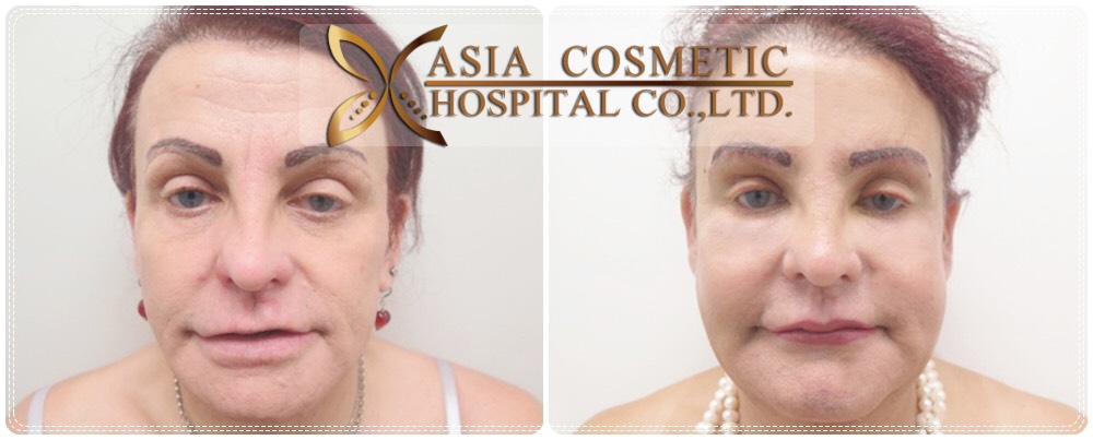 Cheek Implants